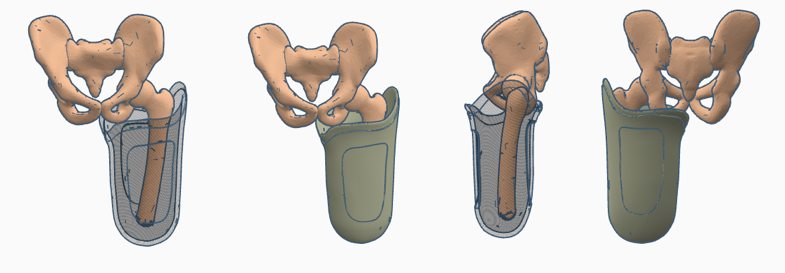 Transfemoral (above-knee) Quadrilateral Prosthetic Socket Pack 2 | 3d print model