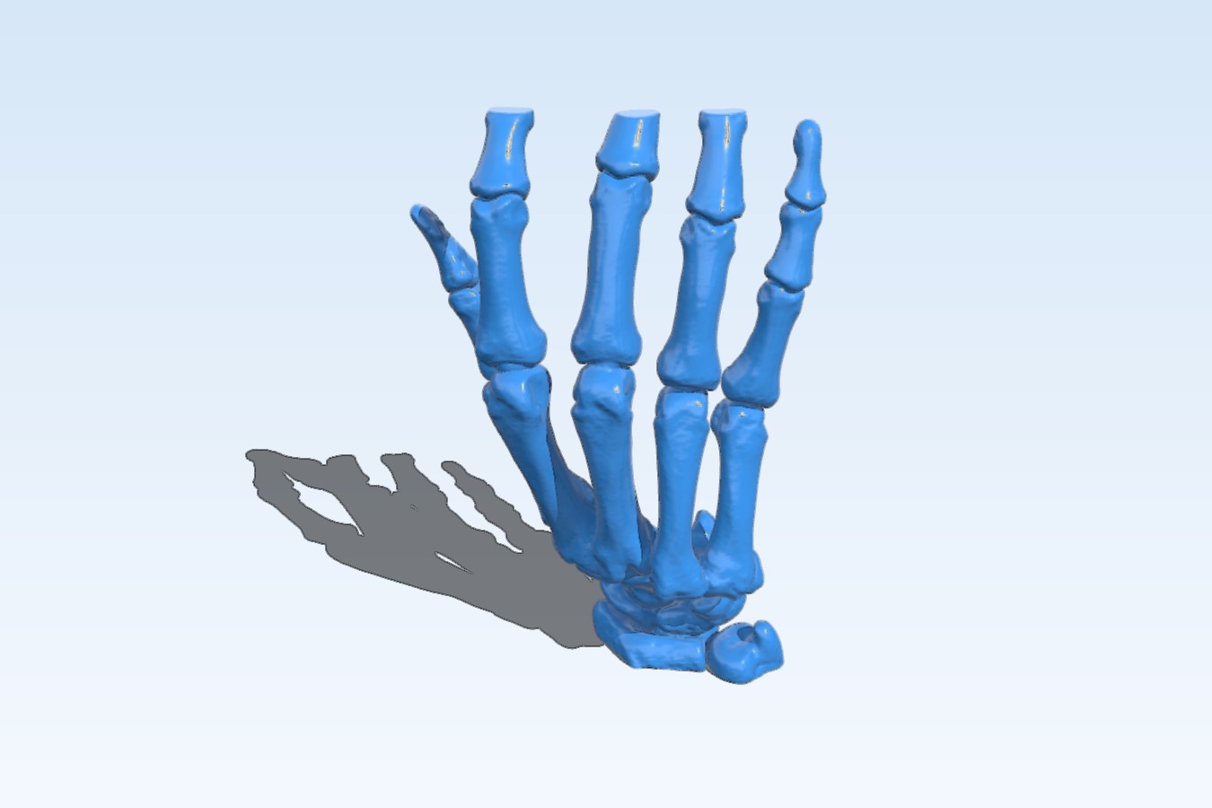 Hand bone. Dislocation 4 and 5 metacarpal joint