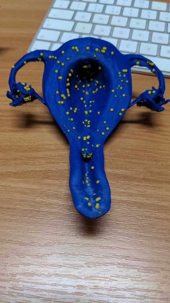 Female Genital Schistosomiasis - Medical Training Device