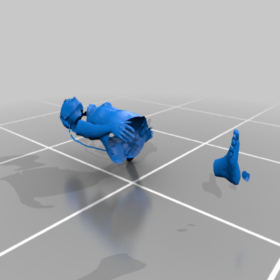 Lipedema distribution classification | 3d print model