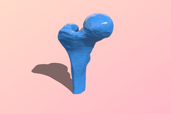 Alberta High School CTS - 3D Printed Bone Replacements | 3d print model